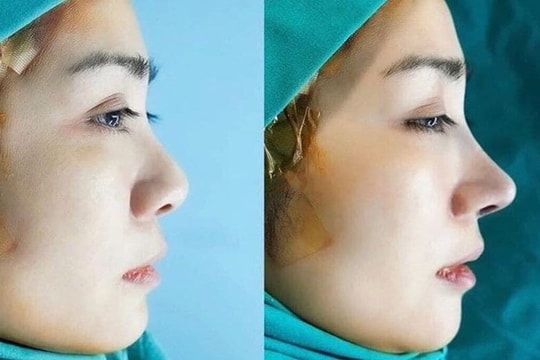 Nâng mũi sụn Surgiform có thần kỳ như lời đồn?
