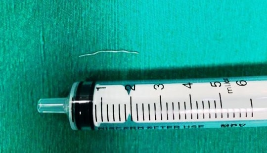 Gắp dị vật kim loại găm trong cổ bé gái suốt 3 tháng