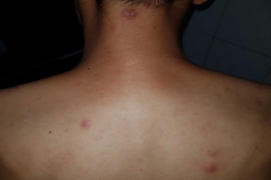Bệnh phong xuất hiện ở Lạng Sơn