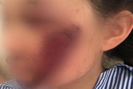Áo chống nắng cuốn vào xe, nữ sinh bị ngã gãy xương mặt