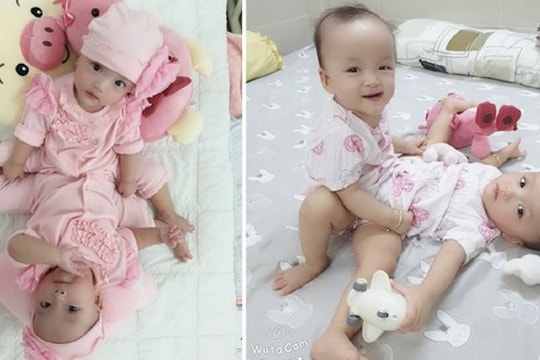 Gần 100 y bác sĩ sắp mổ tách rời hai bé gái song sinh dính liền