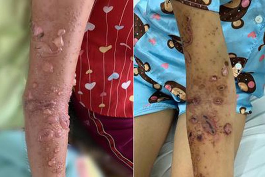 Bị sứa biển cắn, bé 8 tuổi viêm da nặng