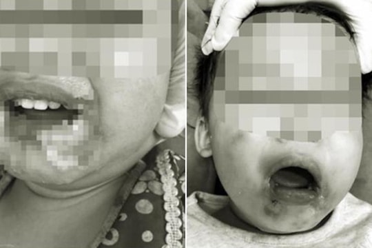 Cắn dây điện, bé 2 tuổi bị hoại tử miệng