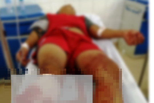 Đối tượng chém đứt lìa chân thiếu niên 15 tuổi ra đầu thú
