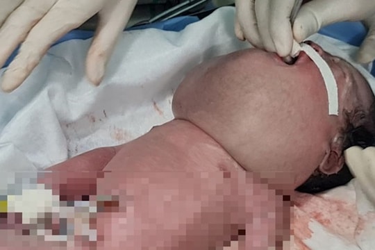 Bé gái sơ sinh có khối u khổng lồ trên mặt