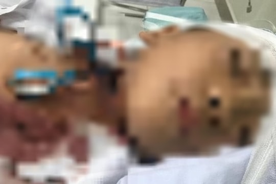 Bé trai 7 tuổi nhập viện với chiếc kéo đâm xuyên vào cổ