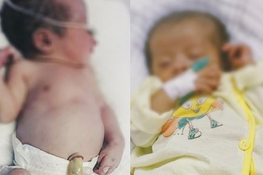 Bé gái mới chào đời mắc bệnh giang mai bẩm sinh