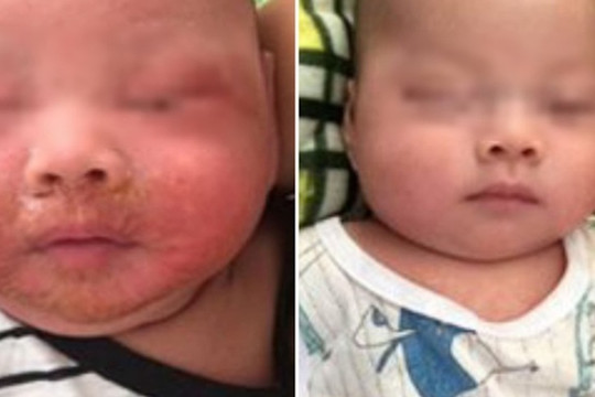 Bé 4 tháng tuổi bong loét da mặt do tụ cầu vàng