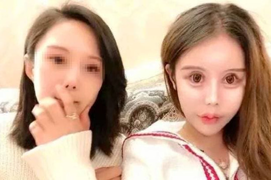 Cha mẹ chi tiền tỷ để biến con gái thành 'quái vật': Mặt trái của phẫu thuật thẩm mỹ thiếu hiểu biết