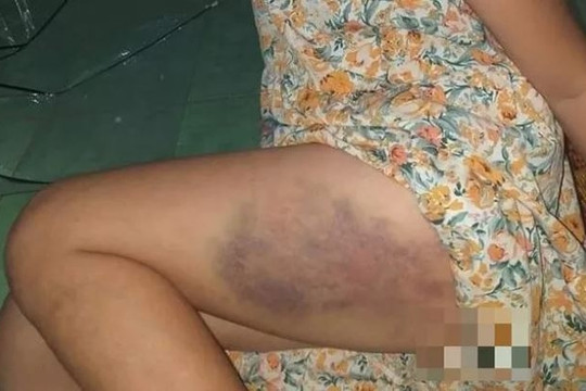 Xác minh việc học sinh lớp 3 bị cô giáo đánh bầm tím đùi