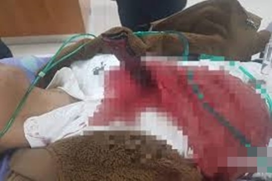 Cứu sống hai thanh, thiếu niên bị đâm thấu tim, phổi