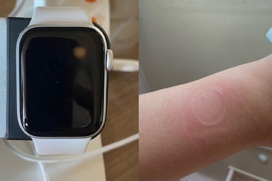 Apple Watch SE bị quá nhiệt làm bỏng cổ tay, hỏng màn hình