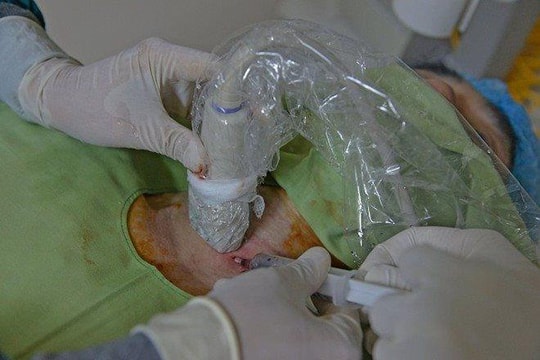 Tiêm cồn điều trị cho người đàn ông từng hút dịch tuyến giáp 30 lần
