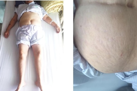 Lạm dụng corticoid trong điều trị bệnh, hậu quả khôn lường