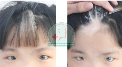 Bé gái bị tai điếc, mắt xanh bởi hội chứng hiếm gặp