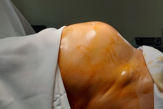 64 tuổi mới đi khám lần đầu, người phụ nữ phát hiện khối u “khủng”