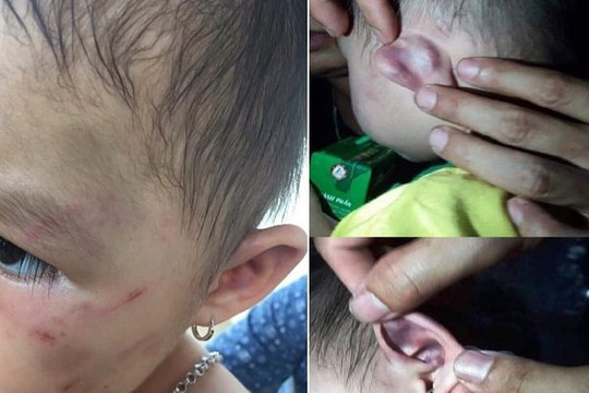 Nghi vấn bé gái 30 tháng tuổi bị bạo hành tại trường mầm non