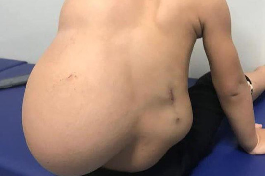 Bé 2 tuổi mang khối u nặng 4kg trên lưng