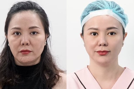 Phái đẹp Việt phát sốt với công nghệ chỉ Be-Young chuẩn y khoa hiện đại Hàn Quốc
