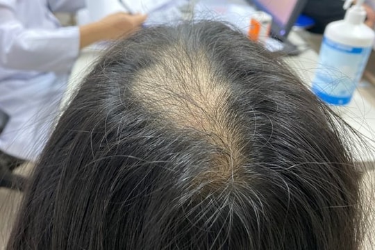 Bé gái 10 tuổi mắc hội chứng nghiện giật tóc
