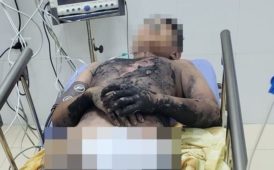 Làm thí nghiệm bằng cồn tại nhà, nam sinh 14 tuổi bị bỏng nặng