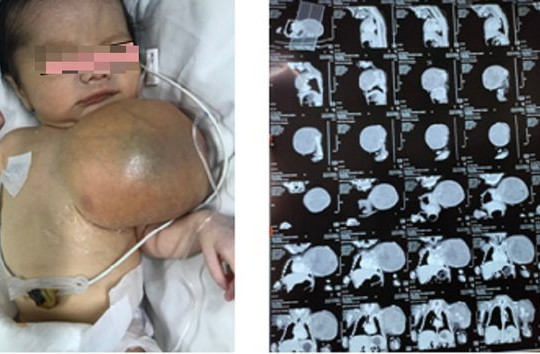 Bé trai chào đời mang theo khối u lớn trên ngực