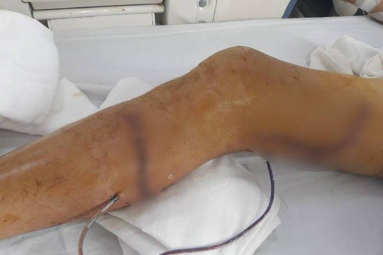 Bác sĩ TP.HCM về miền Tây cứu bệnh nhân bị máy cắt nát chân