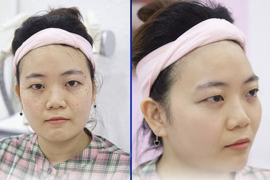Đánh bay nám sau sinh nhờ bí quyết của bà mẹ 2 con