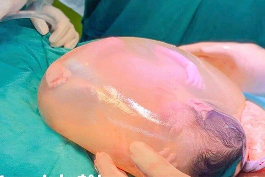 Một trong hai bé gái song sinh chào đời còn nguyên trong bọc ối
