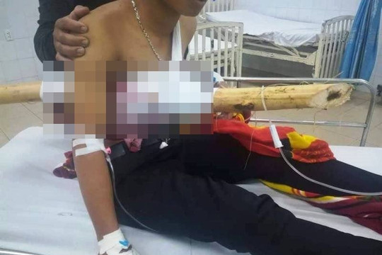 Quảng Ngãi: Nam thanh niên nhập viện khi bị khúc gỗ đâm xuyên người