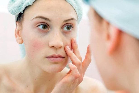 Chuyên gia da liễu lưu ý cách chăm sóc da sau khi trị nám bằng Laser