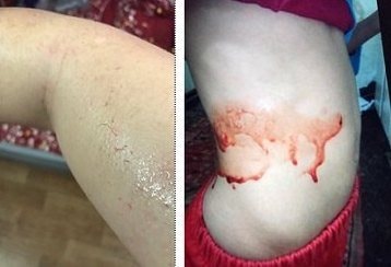 Người đầu tiên tại Việt Nam mắc hiện tượng mồ hôi máu