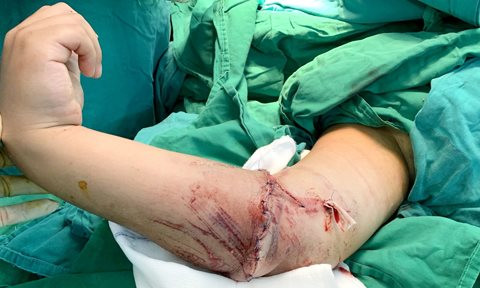 Nối cẳng tay phải bị đứt lìa cho bé trai 8 tuổi