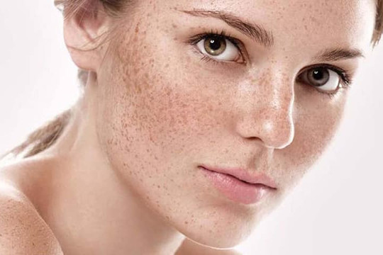 Nhận diện 3 cấp độ nám da và cách điều trị triệt để