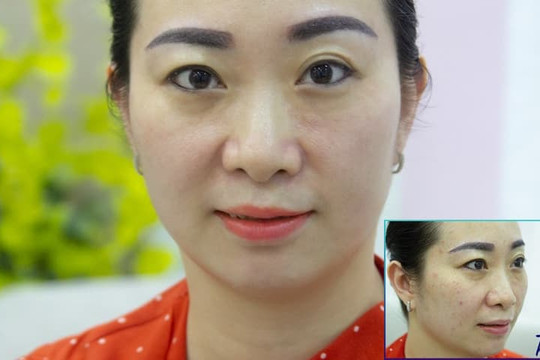 Bí quyết giúp tôi thoát khỏi 10 năm nám sau sinh