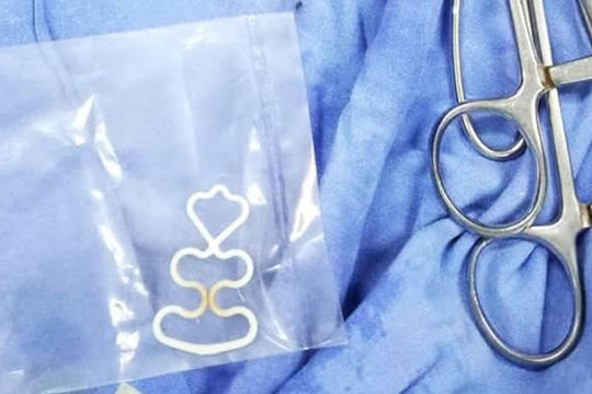 Lấy vòng tránh thai nằm trong người phụ nữ suốt 30 năm 
