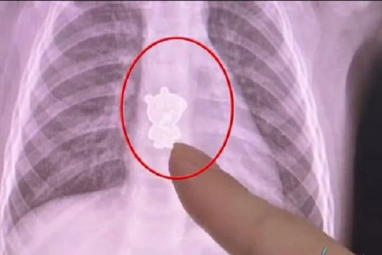 Thấy con liên tục quấy khóc, ho và khạc đờm ra máu, bố mẹ đưa đi bệnh viện khám và phát hiện điều không ngờ