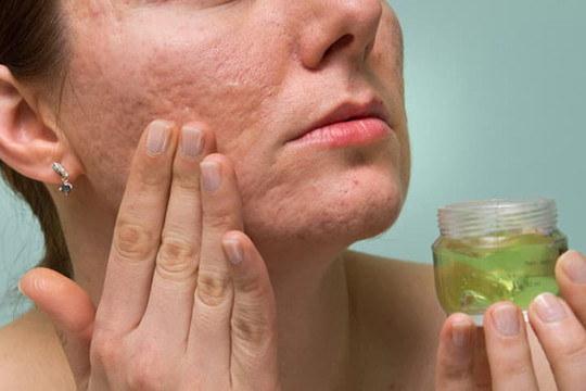 Bật mí 5 cách làm giảm sẹo trên gương mặt nhanh chóng để có làn da mịn màng
