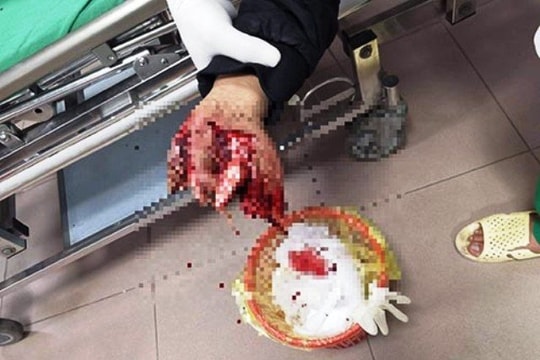 Chơi pháo nổ, nam sinh nát cả bàn tay