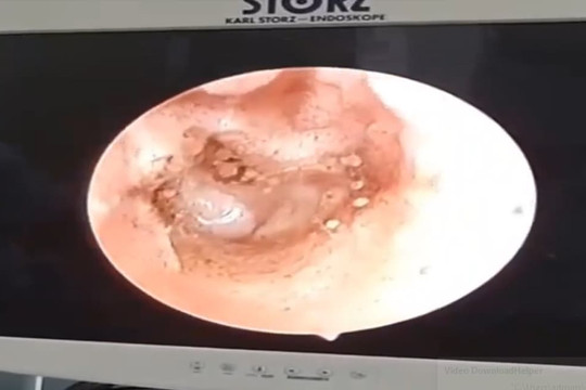 Tá hỏa cảnh hàng chục cây nấm mọc trong tai người đàn ông