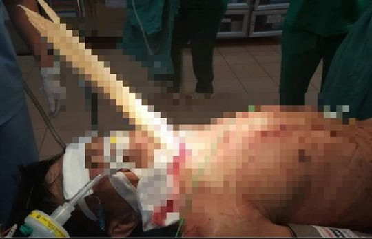Cứu sống người đàn ông bị thanh gỗ dài đâm sâu vào cổ
