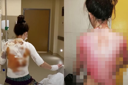 Người chồng 'ác quỷ' dội nước sôi đến lột da vợ chỉ vì bị... gọi dậy ăn sáng