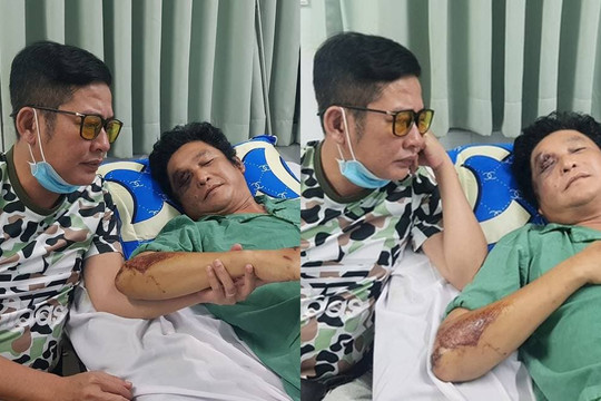 Tấn Beo bất ngờ chia sẻ hình ảnh xót xa của nghệ sĩ Trọng Phúc bị tai nạn, chấn thương mặt và vai