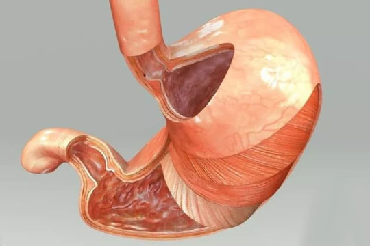 Không muốn bị bệnh dạ dày, bốn loại thực phẩm dù thích ăn đến mấy cũng nên tránh
