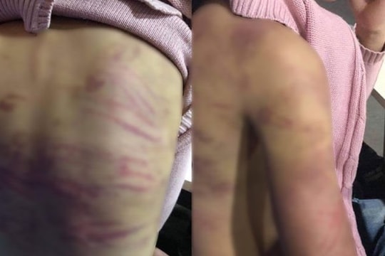 Điều tra nghi án bé gái 12 tuổi bị mẹ đẻ và "cha dượng" bạo hành