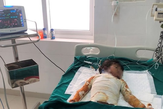 Bé gái 7 tuổi bị bỏng nặng sau khi ngọn lửa bén vào quần áo