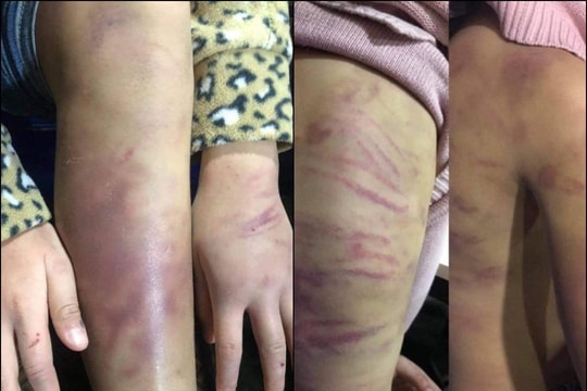 Hà Nội yêu cầu khẩn trương làm rõ vụ bé gái 12 tuổi bị bạo hành