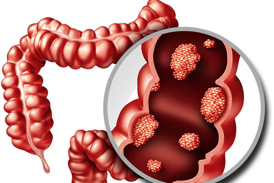 Polyp ruột có trở thành ung thư ruột không? Bạn có biết những câu hỏi này về bệnh polyp ruột?