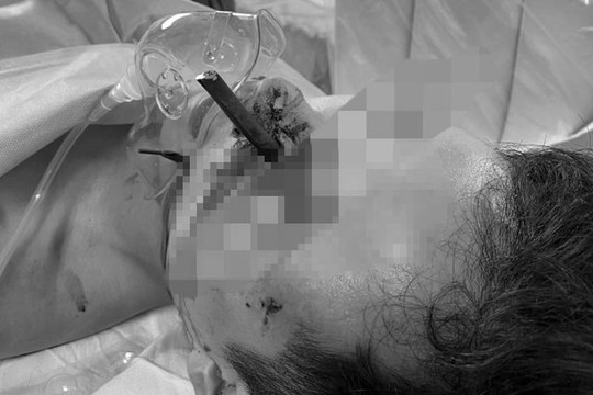 Phẫu thuật thành công thanh niên bị thanh sắt hàng rào đâm xuyên mặt