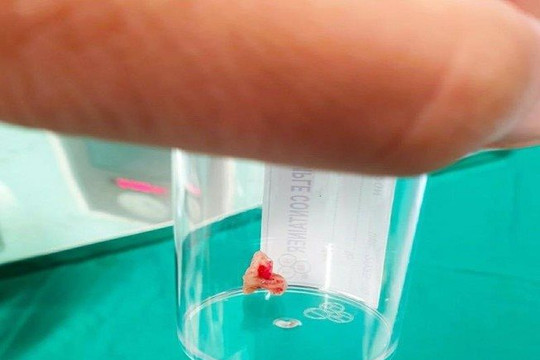 Khó tin: Bé gái phát hiện dị vật trong phổi là chiếc răng hàm